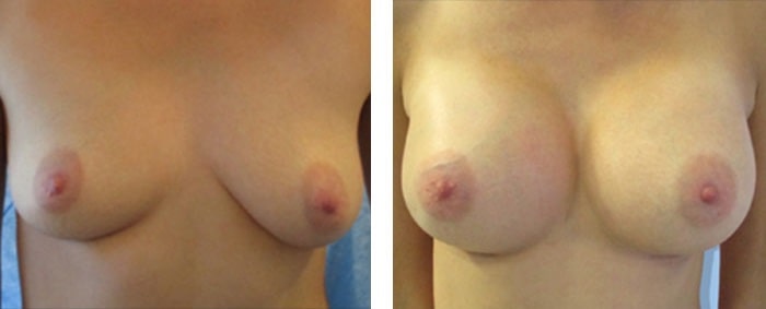 before & after photo of Breast Augmentation