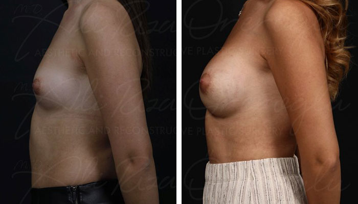 before & after photo of Breast Augmentation