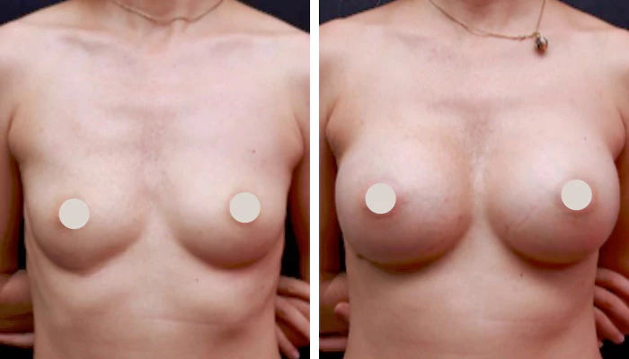 before & after photo of breast-augmentation