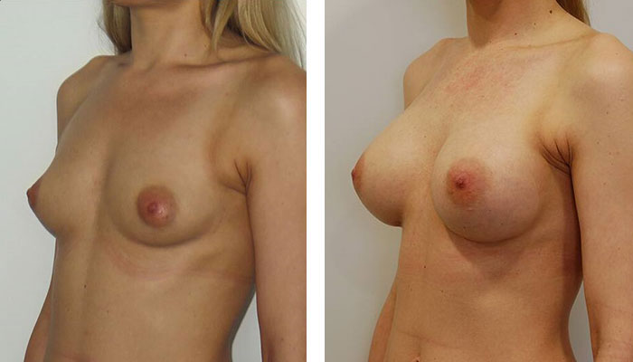 before & after photo of Liposuction