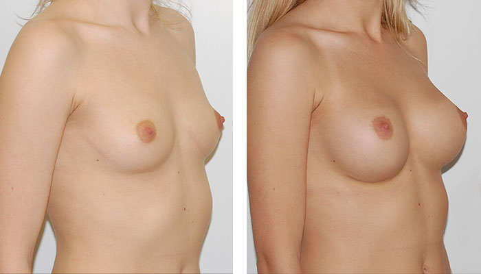 before & after photo of Liposuction