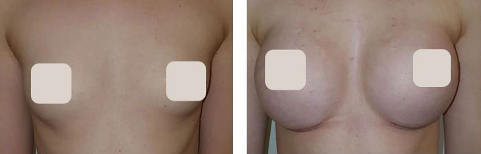 before & after photo of Breast Implants