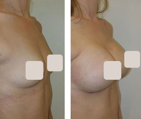 before & after photo of Breast Implants