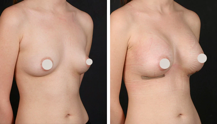 before & after photo of breast-implants