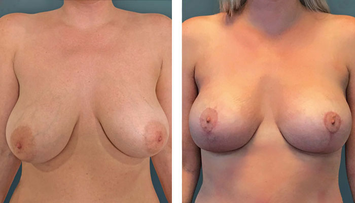 before & after photo of Breast Lift