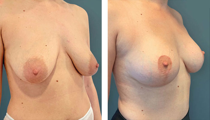 before & after photo of Breast Lift