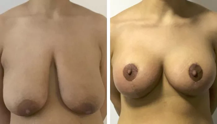 before & after photo of تجميل الجسم بعد الولادة