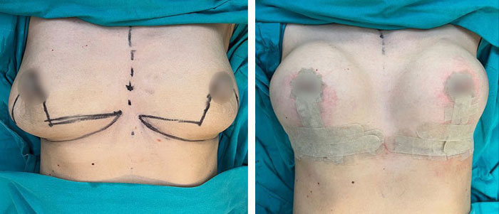 before & after photo of Breast Reduction