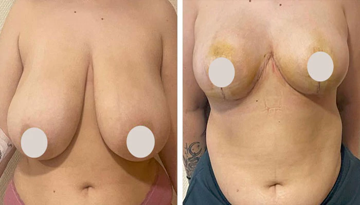 before & after photo of breast-lift