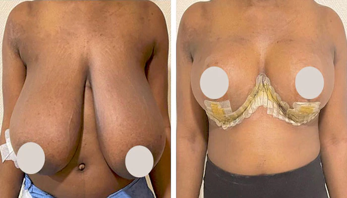 before & after photo of breast-lift