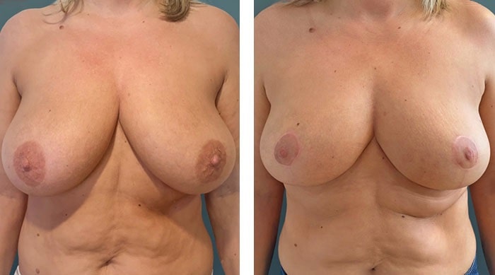 before & after photo of Breast Reduction