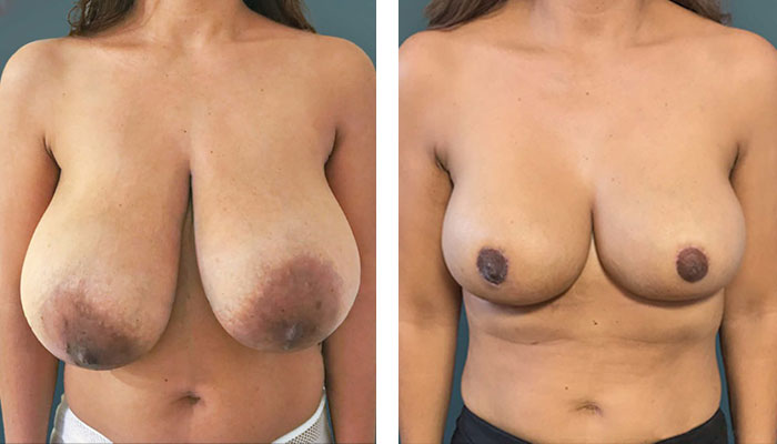 before & after photo of Breast Reduction