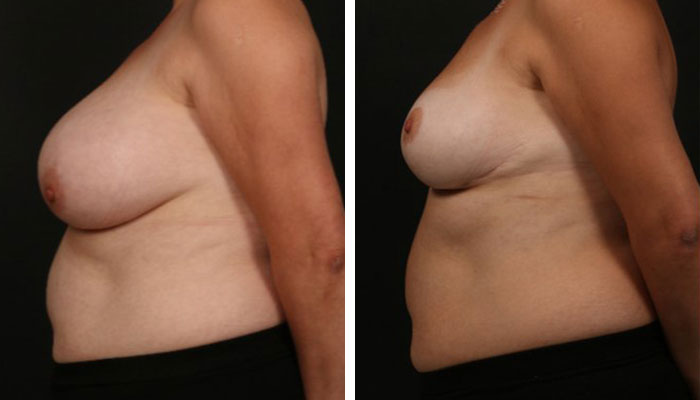 before & after photo of Breast Reduction