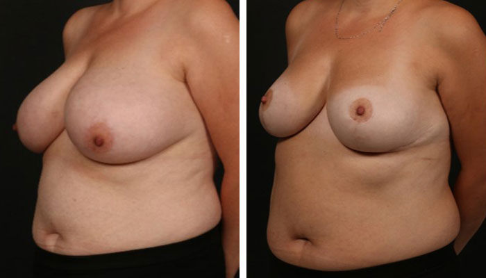 before & after photo of Breast Reduction