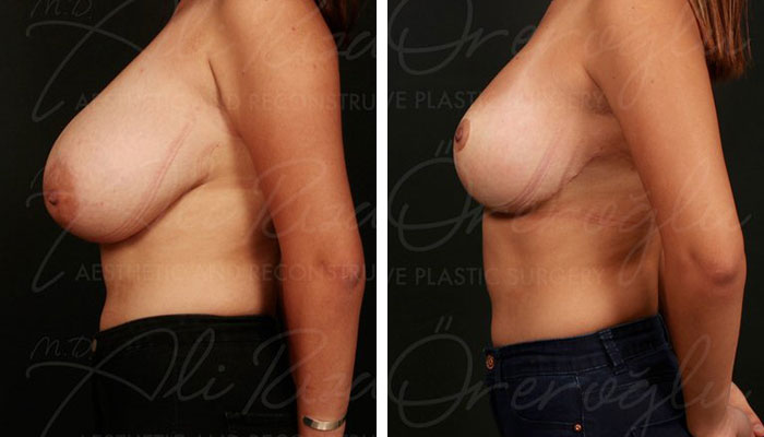 before & after photo of Breast Reduction