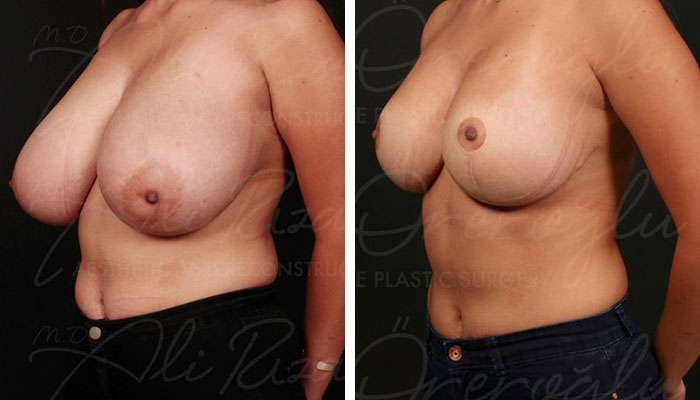 before & after photo of Breast Reduction