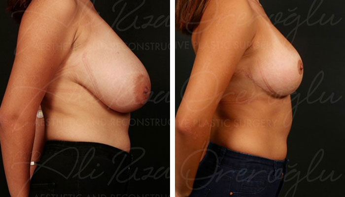 before & after photo of Breast Reduction