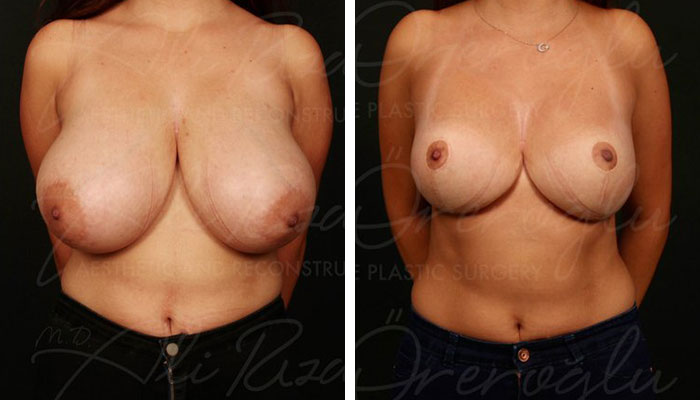 before & after photo of breast-reduction