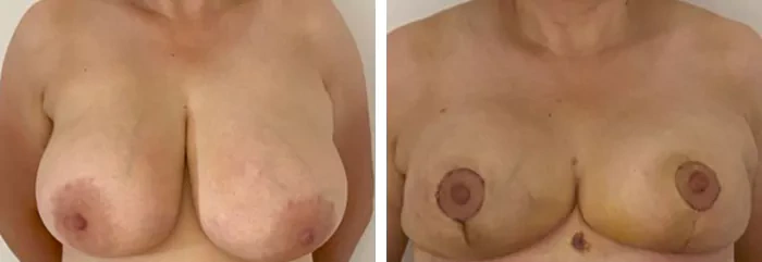 before & after photo of Breast Reduction