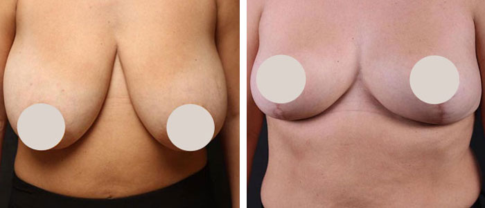 before & after photo of Breast Reduction