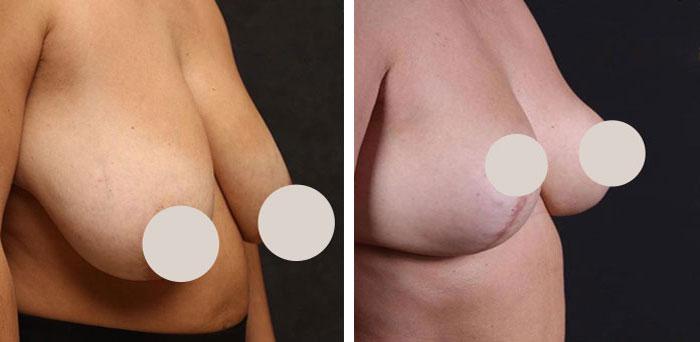 before & after photo of Breast Reduction