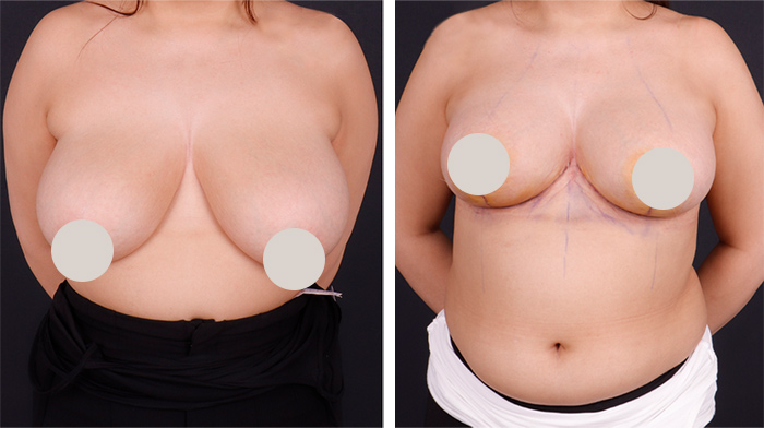 before & after photo of Breast Reduction