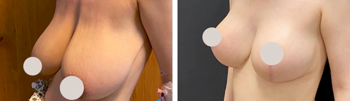 before & after photo of Breast Reduction