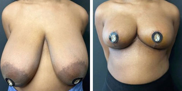 before & after photo of Breast Reduction