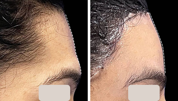 before & after photo of التخلص من بروز الجبهة