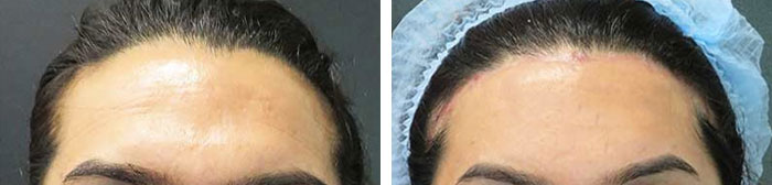 before & after photo of Brow Bone Reduction