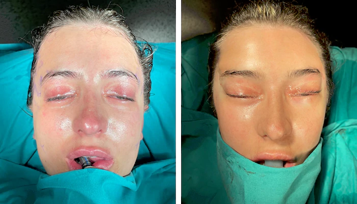 before & after photo of cat-eye-surgery