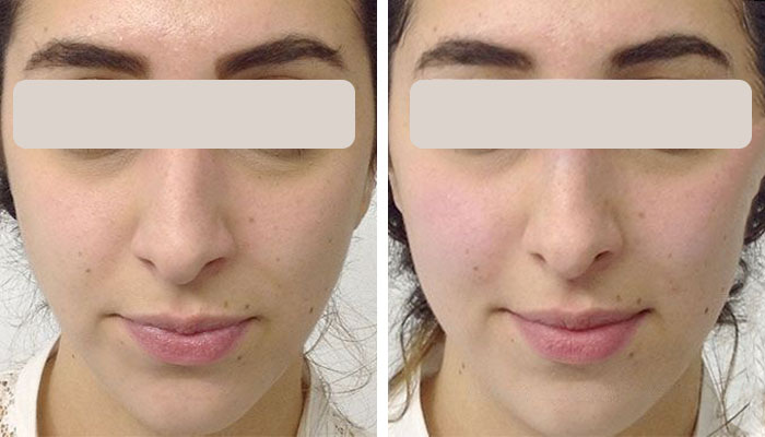 before & after photo of Cheek Filler