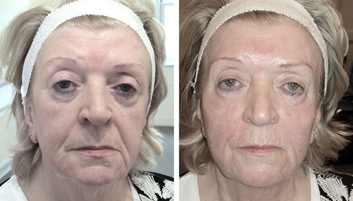 before & after photo of Cheek Filler