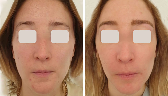 before & after photo of Chemical Peel