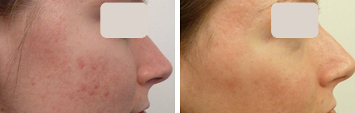 before & after photo of Chemical Peel