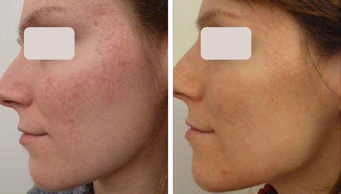 before & after photo of chemical-peel