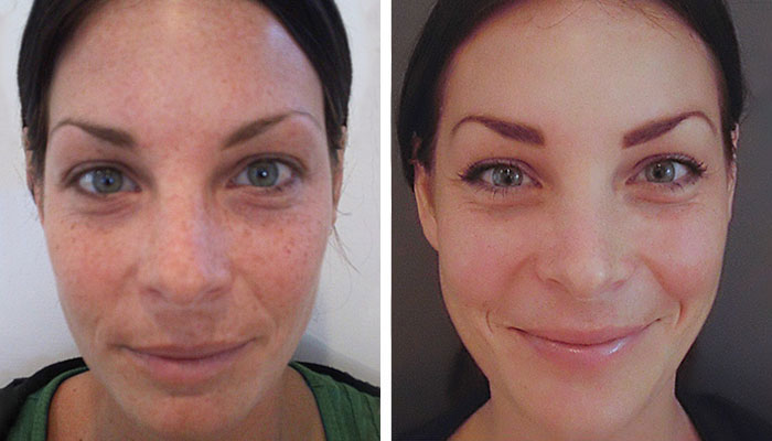 before & after photo of chemical-peel