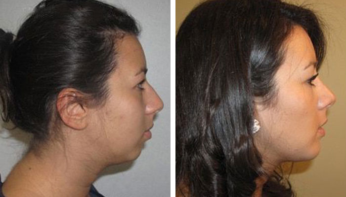 before & after photo of Chin Implants