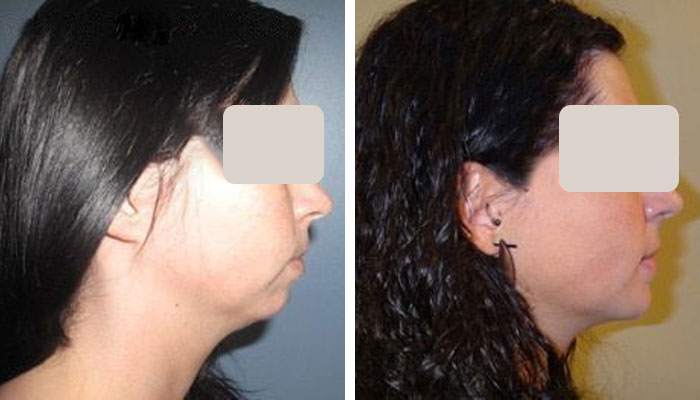 before & after photo of Chin Implants