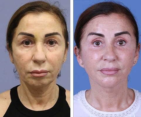 before & after photo of chin-implants