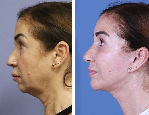 before & after photo of Chin Implants