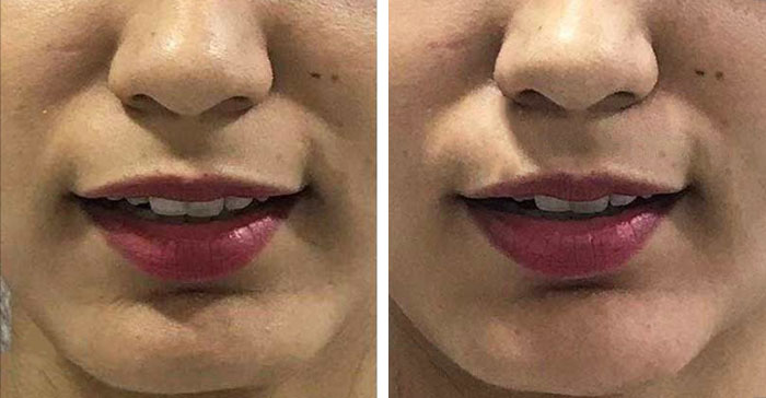 before & after photo of Chin Implants