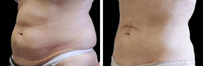 before & after photo of تجميد الدهون