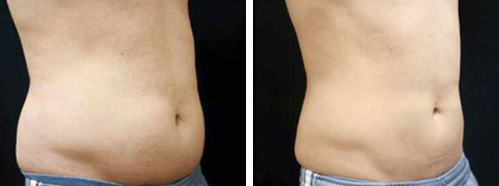 before & after photo of coolsculpting