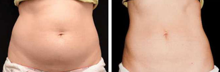 before & after photo of تجميد الدهون