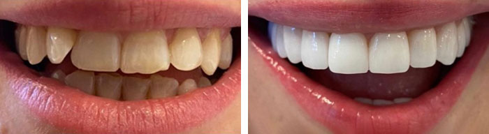 before & after photo of Dental Veneers