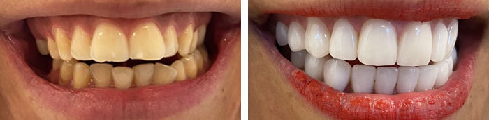 before & after photo of Dental Veneers