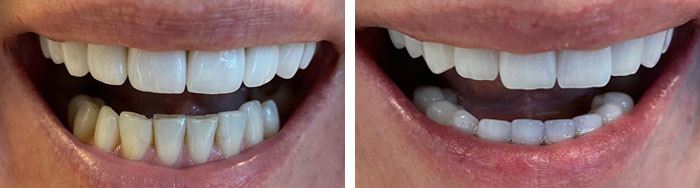 before & after photo of Dental Veneers