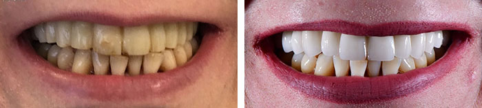 before & after photo of Dental Veneers