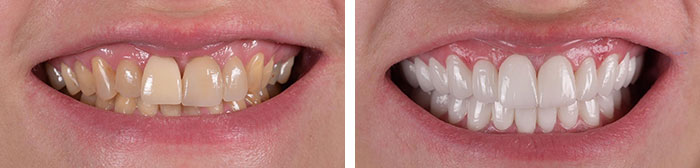 before & after photo of Dental Veneers